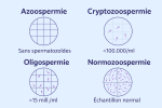 Infographie expliquant les types d'infertilité masculine : azoospermie, oligospermie, cryptozoospermie et normozoospermie